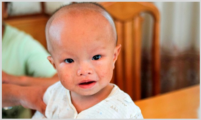 Что такое водянка (гидроцефалия) головного мозга у новорожденных