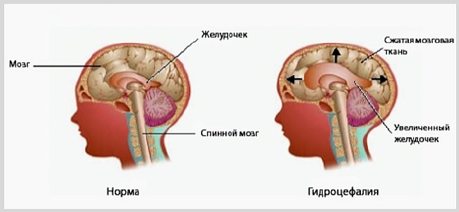 Что такое водянка (гидроцефалия) головного мозга у новорожденных