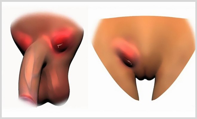 Лимфаденит в паху у женщин и мужчин: особенности лечения