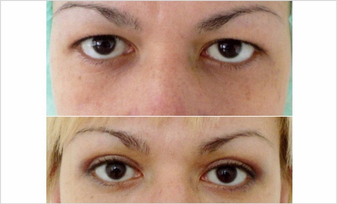 Долго не проходят отеки после блефаропластики