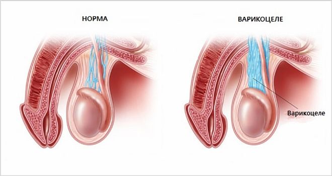 Расширенные вены на яичке у подростков