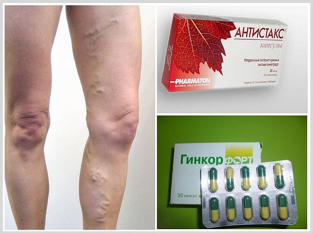 Лучшие препараты от варикоза