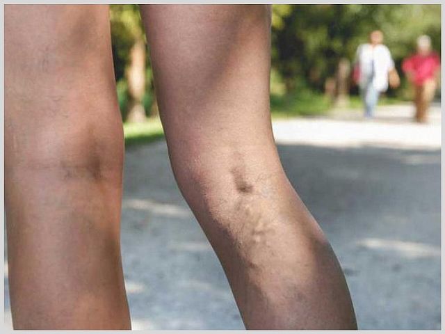 Лучшие препараты от варикоза