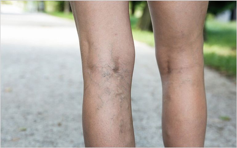 Как выбрать компрессионное белье при варикозе