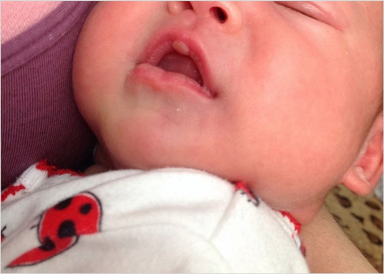 Мозоль на губе у грудничка - что это такое