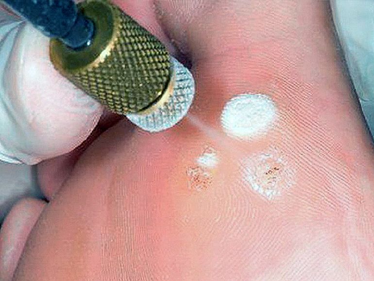 Лазерное удаление бородавок