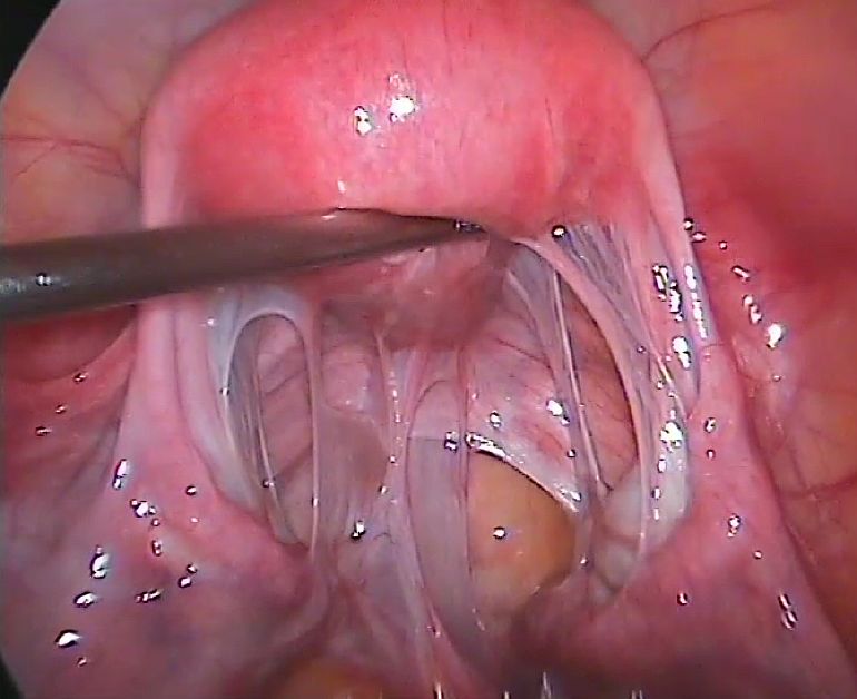 В каких случаях целесообразна лапароскопия при бесплодии?