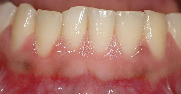 Опухшие десны